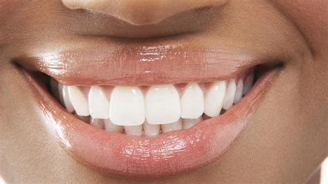 How to maintain your magic white teeth after whitening